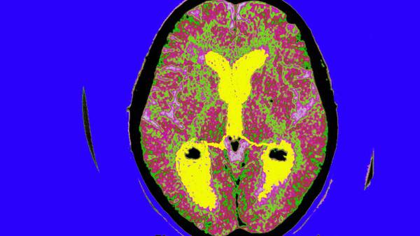 Experimental Alzheimer’s drug slows cognitive decline, study shows